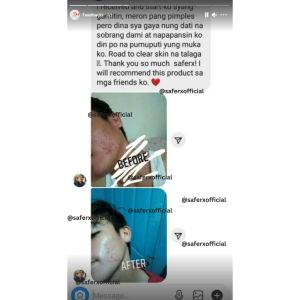 Saferx Korean Skincare Melasma Cream Set: Whitening & Blemish Removal