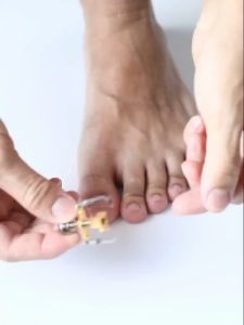 Ingrown Toe Nail Recover Correction Tool Foot Nail Care Orthotic Corrector Pedicure Toenail Fixer