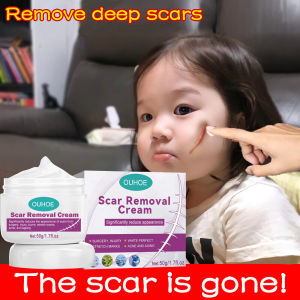 (Barang asli) krim hilangkan parut hitam Scar Remover Cream Hilangkan parut kaki Hilangkan bekas luka lama Hilangkan parut kudis Mosquito bite scar Keloid Fade Scars Burns Parut 疤痕伤疤去除膏
