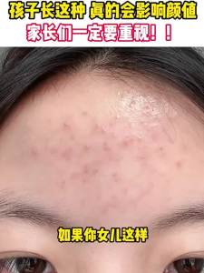 RUYI | Oily Skin Control Acne Clear Moisturizing Skincare Set