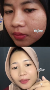 KEZIA Beauty - ACNE PACKAGE SERIES (Facial Wash - Toner - Serum - Day Cream - Night Cream)(FREE 1 LIPCREAM+SERUMSKINRENEW+FACEMIST+UNDERARM+CLEANSINGBALM)