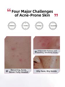 JUNXIAN | Acne Improvement Soothing Repair Face Gel 40ml