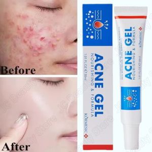 SADOER | Salicylic Acid Acne Faded Face Cream Reduce Pimple Spots Deep Cleaning Pore Anti-acne Scar Oil Control Moisturizer Skin Care