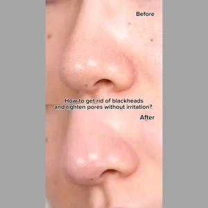 Dụng cụ làm sạch da gạt bã nhờn mụn cám ILSO DEEP CLEAN MASTER ma 110