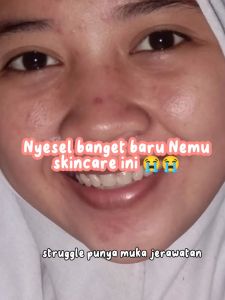 Bening Skincare 1 Paket Acne - Benings by dr Oky Pratama - Penghilang Jerawat dan Bekas - Beruntusan