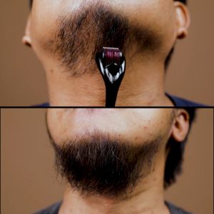 The Angry Beard | Premium Hair & Beard Growth Kit - Hair Grower - Beard Grower - Beard Roller Set