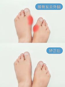 เท้าซิลิโคนนิ้วชี้ ระหว่างนิ้ว ป้องกันผิว ลดเสียดสี 1คู่