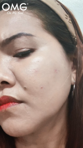 OMG Pimple Off 1% Salicylic Acid Gentle Acne Cream