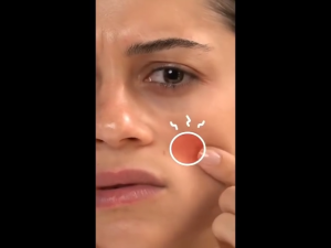 360pcs Acne Patches Effective Acne Removal Anti-inflammatory and sedative Waterproof Acne Patches Facial Skin Care