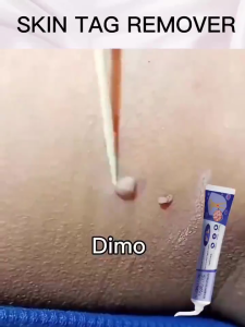 Wart Remover Ointment Wart Removal Cream Genital Wart Removal Cream Mole Skin Tag Remover Mole Mole Repellent