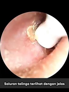 Korek Kuping LED lampu Smart Pembersih Telinga Kamera LED WiFi untuk Bayi Dewasa Earpick Endoskopi