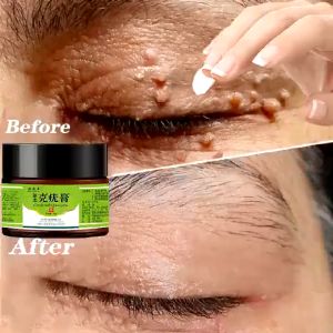 Wart Remover Mole Remover Cream Warts Removal Cream Wart Removal Mole Remover Skin Tag Remover Wart Remover Ointment