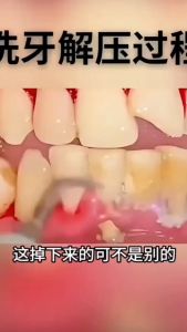 【One-click removal of tartar】Ultrasonic Dental Scaler Ultrasonic Sonic Dental Scaler electric teeth cleaner Deeply clean dirt teeth and gingival grooves and tartar to prevent tooth decay and bad breath without hurting gums oral care