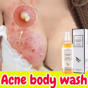 Sabun Jerawat Badan 260 Ml Aroma Alami Mengatasi Kulit Jerawat Kering Gatal Antibakteri