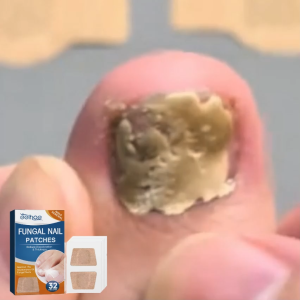 EELHOE Toenail Repair Patch (Grey) – Suitable for fungal infections nail thickening and softening paronychia fingernail correction and ingrown nails.