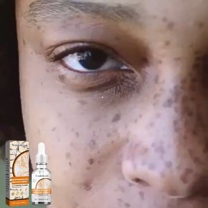 ครีมทาฝ้า ครีม แก้ ฝ้า กระ e ทาฝ้าของแท้ ครีมทาฝ้าหนาๆๆ 30ml ครีมกำจัดฝ้าวิตามินซี ครัมทาฝ้ากระ กำจั จุดด่างดำ กระ ให้ผิวขาวขึ้ ให้ความชุ่มชื้นต่อต้านริ้วรอย whitening Freckle Serum