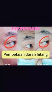 EYE MISSION BLING EYE DROPS / 1BOX PER MONTH / CATARACT / GLAUCOMA / FLOATERS / EYE NERVES / RED EYES / MYOPIA / ARMD / PRESBYOPIA
