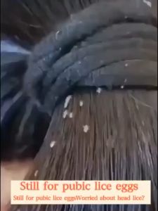 [Remove and prevent lice] shampoo 100ML Effective removal Head lice Pubic lice and lice eggs in 15 minutes 100% non-relapse Oil Control Dandruff Shampoo Anti dandruff shampoo hair follicle shampoo Lice Shampoo Children shampoo kutu rambut anak