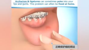 Lilin Pelindung Gigi Ortho Wax Behel: Manfaat & Cara Penggunaan