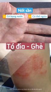 Kem Bôi Nọc Ong Hbesty - Giúp Giảm Mụn Nước Chàm Eczema Tổ Đỉa Á Sừng Hiệu Quả. Làm Dịu Ngứa Phục Hồi Da Tổn Thương. Chiết Xuất Tự Nhiên An Toàn Phù Hợp Với Da Nhạy Cảm. Dễ Thấm Không Nhờn Rít Dùng Được Hằng Ngày | MOSKA SHOP