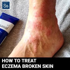 Pharmaceutical Grade - Eczema/Sensitive Skin Wound Care Set -Broken/Scratched/Raw Eczema/TSW