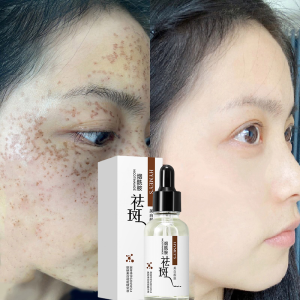 Essence Pemutih & Menghilangkan Flek Hitam: Niacinamide untuk Menghilangkan Noda Hitam