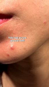 Junkie Makeup - Pigeon Teens Acne Ranger Gel 15ml