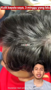 KIROZI Shampoo Anti Ketombe Dan Rontok Piroctone Olamine & Climbazole Original