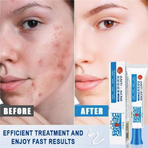 【Effective In 3 Days】Original Anti-Inflammatory And Analgesic Acne Cream Fast Acne Gel Fade Acne Marks Repair Acne Pits Shrink Pores Facial Scar Care Acne Removal Acne Cream Facial Repair Cream Repair Acne Acne Fast Acne Cream