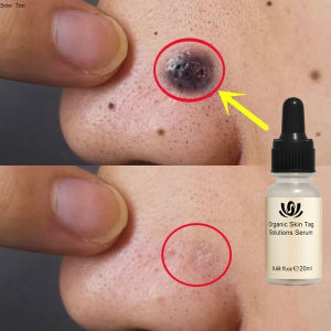 Skin Tag Remover Penghilang Kutil Tanpa Luka Serum Perbaikan Flek Hitam Memudarkan Flek Memutihkan Tanpa Bekas 20ml