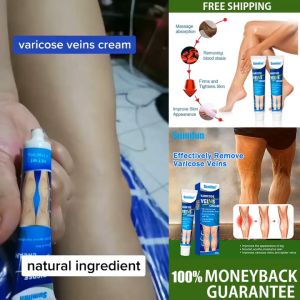 Original Varicose Veins Effective Remover Varicose Vein Remover Cream Ugat Remover Cream