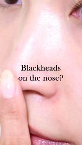 RNW 黑头贴RNW 2 Step Clear Nose Pack (2nd Gen)RNW Blackhead Removal Nose Pore Strip祛黑头粉刺鼻贴 鼻头贴