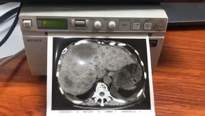 ORIGINAL Sony Ultrasound Thermal Paper UPP 110S Type 1 - 1 roll