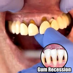 Gum Therapy Gel Teeth Repair Gel Gum Relieve Gingival Care Gel Gum Recession tooth loosening bleeding gums Oral Care牙龈凝胶