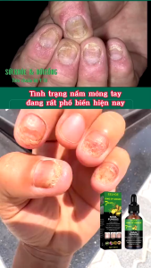 Serum Nail Fungus Huyết Thanh Nấm Móng - Gừng Già Dành Cho Người Bị Nấm Móng Thối Móng Hư Móng Diệt Nấm Tận Gốc Ngăn Ngừa Tái Phát Phục Hồi Móng Hư Tổn Cải Thiện Cấu Trúc Móng Kích Thích Mọc Móng Dưỡng Móng Chắc Khỏe Làm Sáng Móng Của Mỹ | Moska