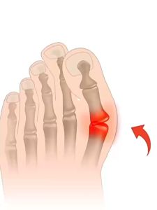 2 Pcs Insole Toe Corrector Insole Silikon Pemisah Jari Kaki Anti Bunion Anti Bunion Untuk Pedikur Dan Kesehatan Kaki