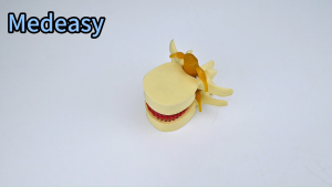 Spinal model Lumbar intervertebral disc protrusion model