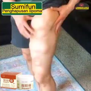 Lipoma Removal Cream 30g - ครีมก้อนเนื้องอกไขมัน สำหรับปัญหาใต้ผิวหนัง กับถุงใต้ผิวหนัง ผลลัพธ์ระดับนั้น ครีมทาเนื้องอกไขมัน