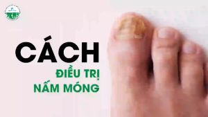 Dưỡng móng tay chân ELLHOE Hết Sạch Nấm Bọng Móng Hư Khoé Nước Ăn Tay Chân Dưỡng Cứng Móng