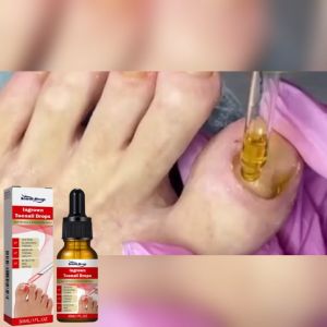 SOUTH MOON Anti Paronychia Relief Oil Ingrown Toenail Drops Soften Nail Reliever Nail Fungal Feet Care Essence Softener Fungal Nail Anti Infection Paronychia 30ml
