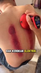 COD GARANSI - Alat Kerok Bekam Badan Massager Alat Kerik Elektrik Scraping Massage Plus