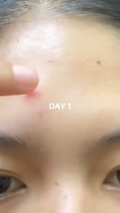 【BUY 1 TAKE 1】20% Azelaic Acid Acne Cream: Effectively treats acne fades acne scars reduces acne marks removes blackheads and reduces pigmentation. Suitable for both men and women.