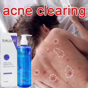 [IUALLURE] Solution Acne & Miracle Acne Clear Body Wash 300ml | Face Wash | Clear Skin | jerawat remover | Blemish & Oil Control Hydrating Foaming Wash | 除蟎沐浴露
