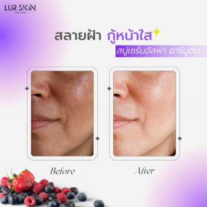 [ส่งฟรี] LUR SKIN MELASMA ALPHA ARBUTIN  SERUM SOAP 100g. (1 แถม 1) สบู่เซรั่ม เมลาสม่าร์ อัลฟ่าอาร์บูติน สบู่ฝ้า กระ จุดด่างดำ ฟื้นบำรุงผิว