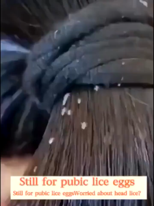 100mL lice remover shampoo Licealiz Head Lice Treatment Shampoo treatment lice remover shampoo 4.8 7.4K ratings 10K+ Sold