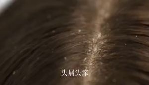 Sampo buat ketombe Shampoo Anti Dandruff Removes Dandruff Contains anti ketombe Coconut shampo Sampo anti gatal dan ketombe Sampo ketombe parah berkerak psoriasis Pembersihan lembut dan pengontrol minyak