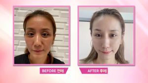 คุ้มสุดๆ 10 แถม 10 Barcony ครีมหน้าเด้งโสมเกาหลี ครีมยกกระชับ Lifting Perfect บาร์โคนี่ นวัตกรรมความงามจากเกาหลี