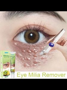 Fat granule cream Periocular fat granules 20g Improve fat granules Moisturizing the skin Quick removal Vitamin E Fat Granule Cream Sweat duct granules