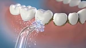 Water Flosser Replacement Tips Dental Water Jet Tip Oral Hygiene Accessories Replacement Compatible Brand Oral Irrigator Nozzles