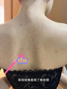 Premium Japan Formula Acne Care Toner & Mists - Pore Minimizing & Skin Tightening